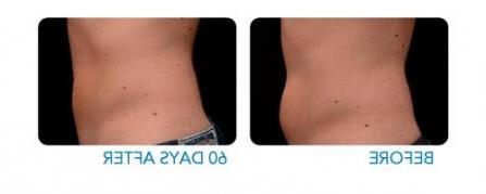 CoolSculpting before and after - example 1
