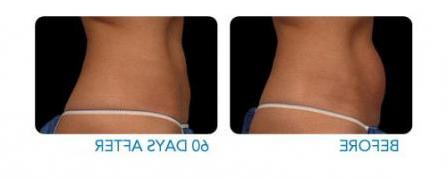 CoolSculpting before and after - example 2