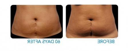 CoolSculpting before and after - example 3